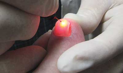 Laser Nail Care
